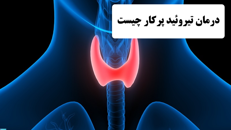 تیروئید پرکار چه خطراتی دارد | برای تیروئید پرکار چی خوبه | درمان پرکاری تیروئید در طب سنتی | درمان خانگی تیروئید پرکار