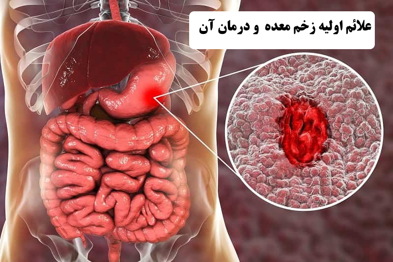 علائم اولیه زخم معده و درمان آن | علت زخم معده | درمان قطعی زخم معده | درمان گیاهی زخم معده | علائم زخم معده و سرطان معده