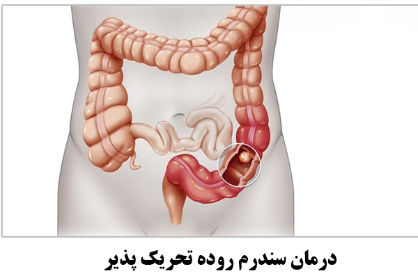 درمان سندرم روده تحریک پذیر با طب سنتی 