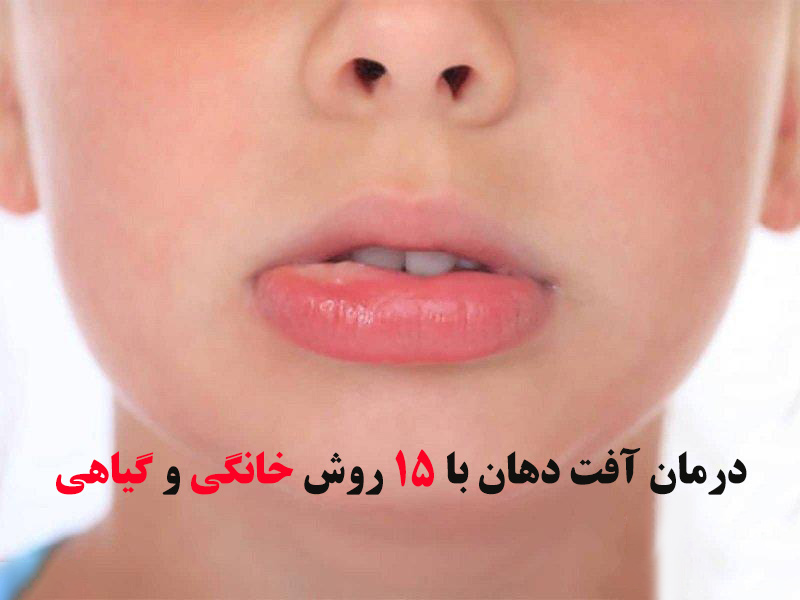 درمان آفت دهان با 15 روش خانگی و گیاهی