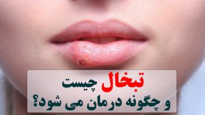 تبخال چیست و چگونه درمان می شود؟ ✔️ تبخال لب چیست ✔️ درمان خانگی و سریع تبخال ✔️  تبخال صورت ✔️ تأثیر رژیم غذایی بر بهبود تبخال ✔️ رفع تبخال در سه دقیقه