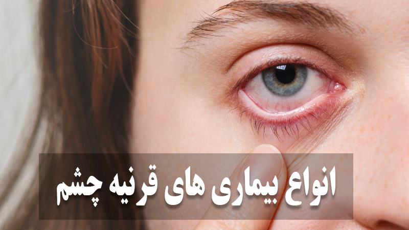 انواع بیماری های قرنیه چشم 