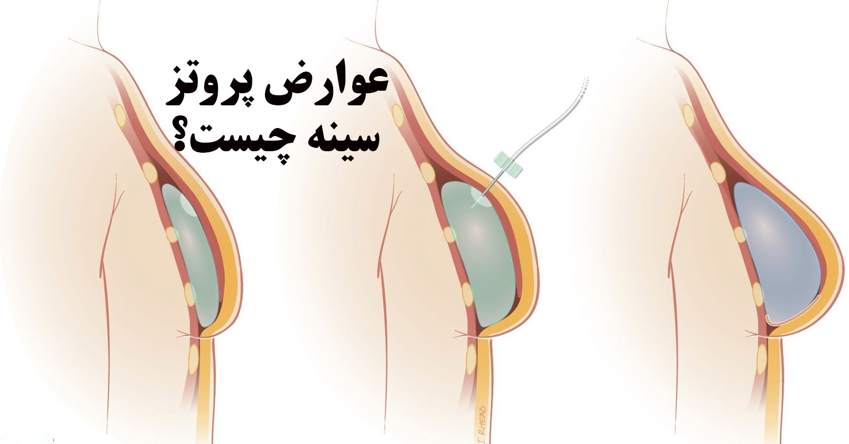 عوارض پروتز سینه چیست؟ 