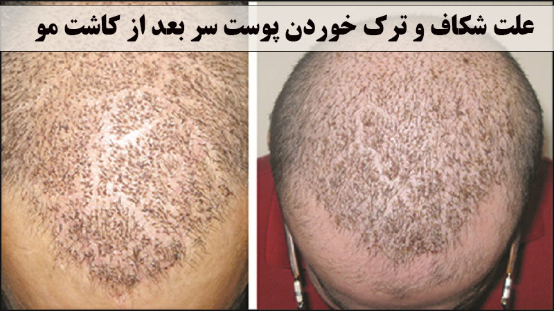  ترک خوردن پوست سر بعد از کاشت مو ✔️  ترک و شیار روی سر بعد از کاشت مو ✔️ چه زمانی بعد از کاشت مو ترک ایجاد می شود ✔️ راه های پیشگیری از ترک های پوست سر 