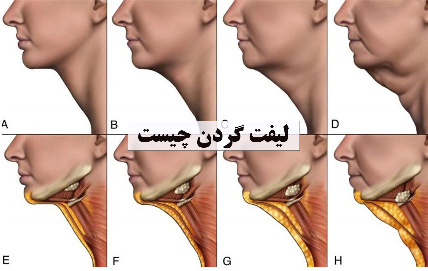 لیفت گردن ✔️ لیفت گردن چیست ✔️ لیفت گردن چگونه انجام می شود ✔️ لیفت گردن برای چه افرادی مناسب است ✔️ نکات مهم قبل از جراحی لیفت گردن ✔️ روش های انجام جراحی لیفت گردن ✔️ نکات بعد از انجام جراحی لیفت گردن