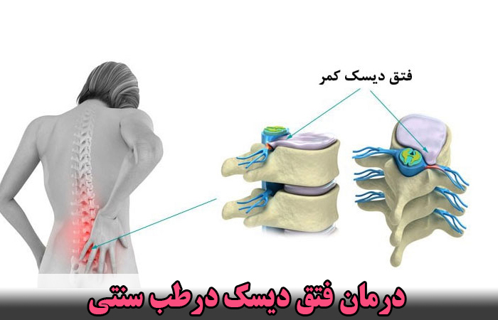 درمان فتق دیسک درطب سنتی