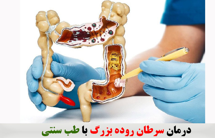 درمان سرطان روده بزرگ با طب سنتی✔️ سرطان چیست ✔️ درمان سرطان روده بزرگ ✔️ سرطان روده بزرگ ✔️ جراحی سرطان روده بزرگ ✔️ انواع سرطان روده بزرگ